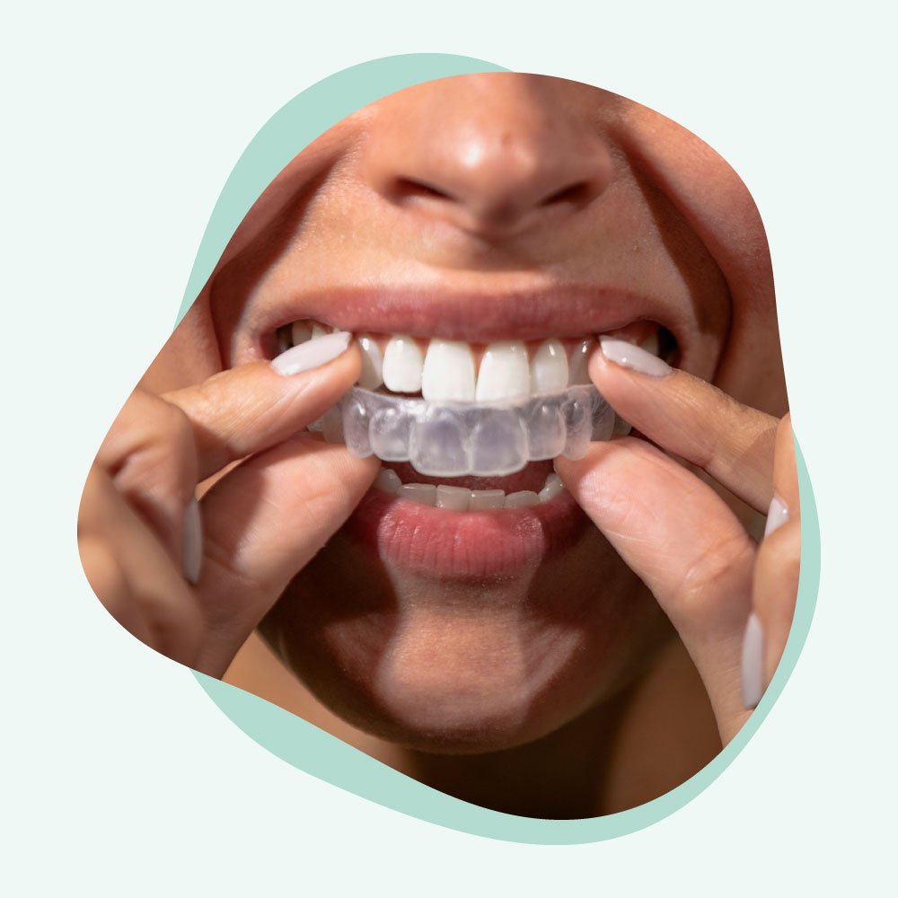 Lumos Smile Teeth Whitening - Customized Whitening Trays